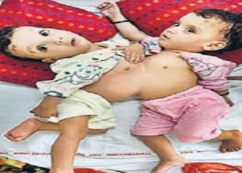 ऑपरेशन के पहले जुड़वा बच्चे की तस्वीर.